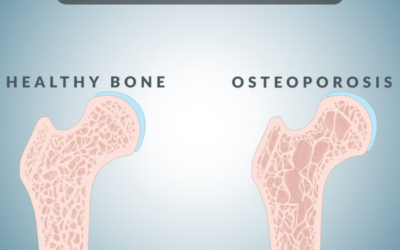 Bone Health After 30: What Most People Ignore